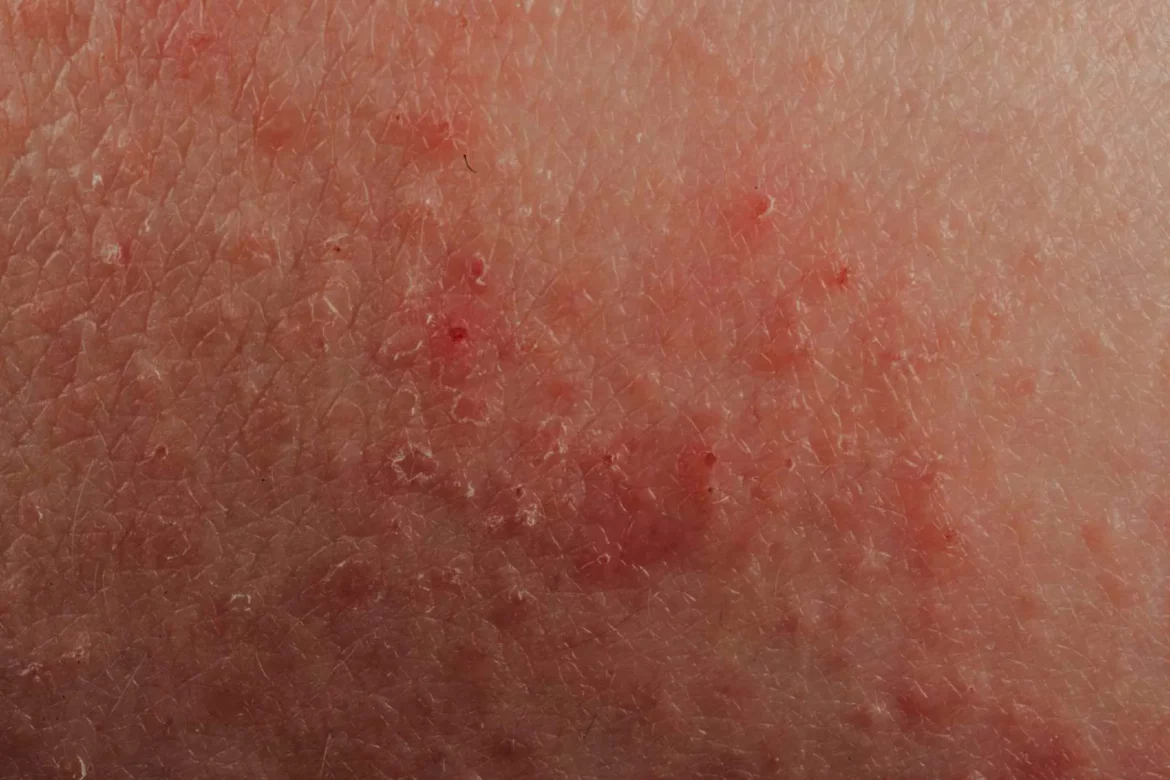 Eczéma